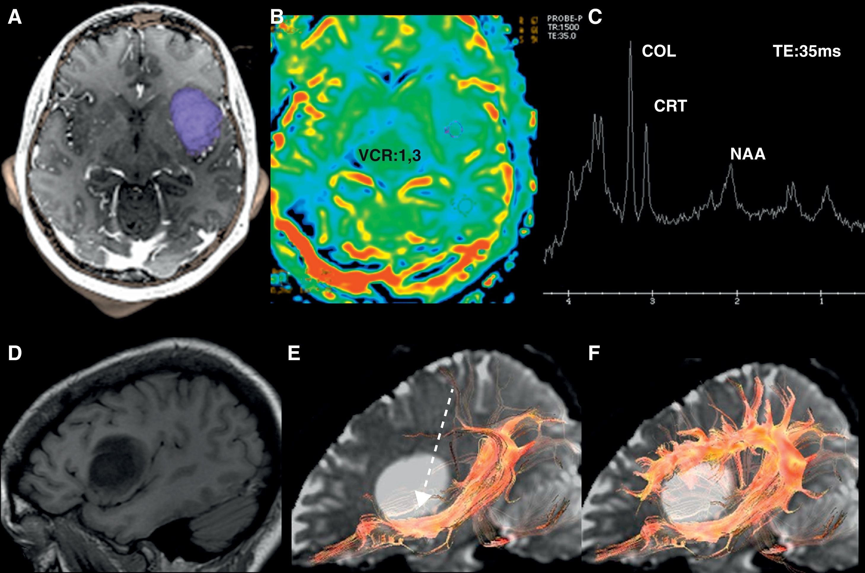 Mapeo cortical en IONS
